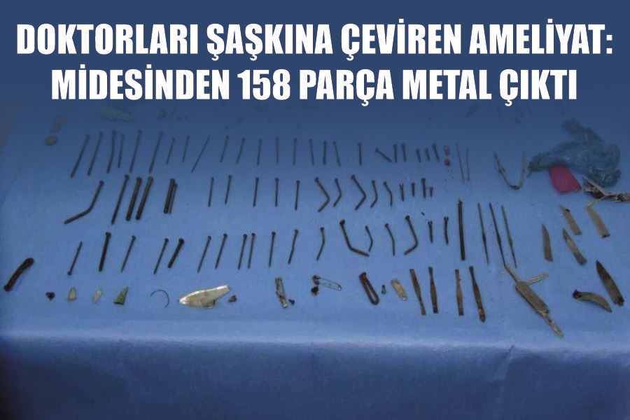 Doktorları şaşkına çeviren ameliyat: Midesinden 158 parça metal çıktı
