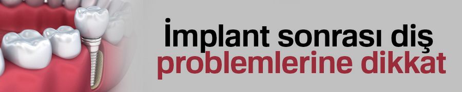 İmplant sonrası diş problemlerine dikkat